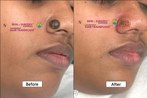 Before and after treatment result at Skin & Hair Surgery, Pune