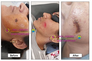 Before and after treatment result at Skin & Hair Surgery, Pune