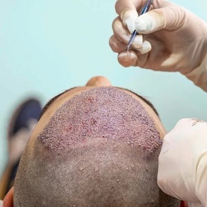 Fue Hair Transplant