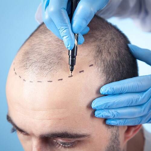 Fue Hair Transplant