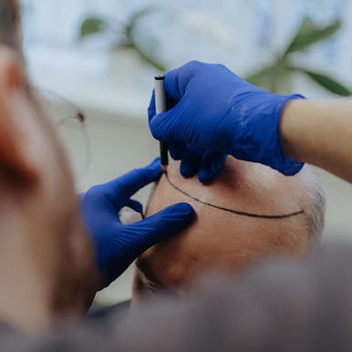 Hair loss treatment in Pune by expert dermatologist for hair regrowth