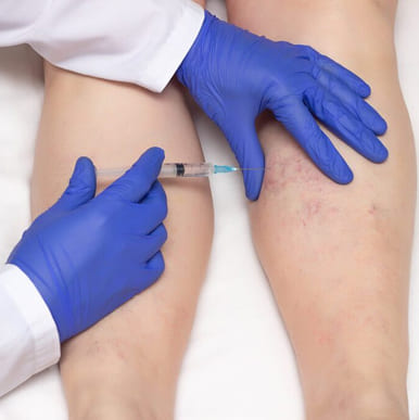 sclerotherapy treatment in pune