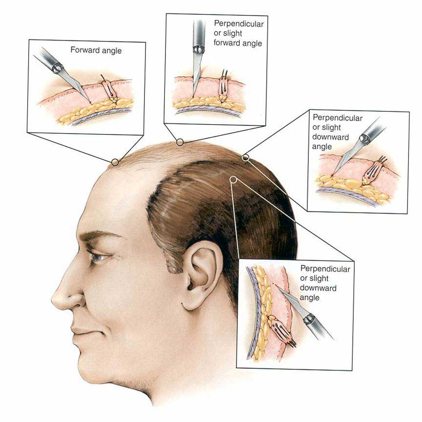 hair transplant process