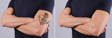 tatoo removal in pune